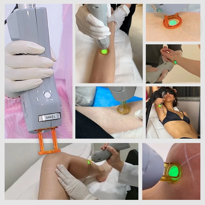 alexandrite laser hair removal alexandrite laser hair removal
