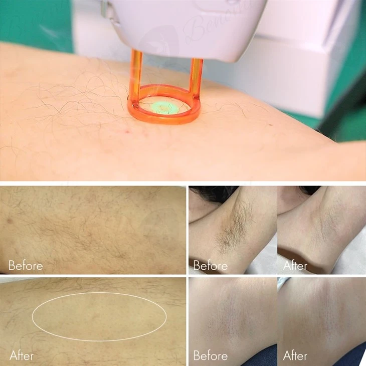 Alexandrite Laser 755 1064nm Hair Removal Machine